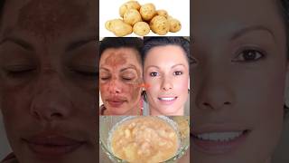 Potato to treat pigmentation, dark spots, acne scars | Potato Face Mask #ashortaday #trending