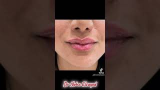 Lip filler ❤️👄 #lips #rejuvenation #اكسبلور #الذكاء_الاصطناعي #botox #خيوط #lipfiller #فيلر_الوجه