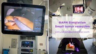 Small tumor resection | Robotic-assisted partial nephrectomy