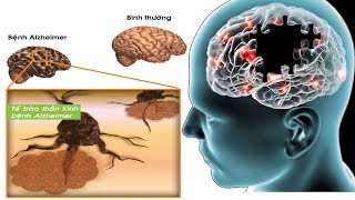 6 thực phẩm bảo vệ não và phòng ngừa bệnh Alzheimer