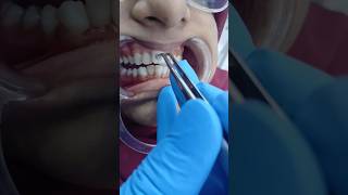 Braces treatment #dentist #dentalsmiledesigning #dentaltreatment #smiledentist #dentalclinic #smile