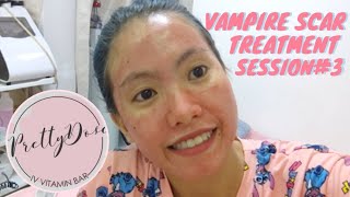 SESSION 3 VAMPIRE FACIAL SCAR TREATMENT | PRETTYDOSE DAVAO