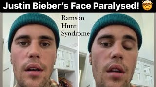 Justin Bieber Face Paralysed | Ramson Hunt Syndrome | What happened to Justin? #justinbieber