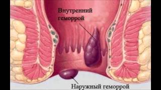 Начальная стадия геморроя