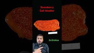 Strawberry gall bladder #drkrishna #neet #mbbskyrgyzstan #ihsm #biology #medicalmicrobiology #scienc