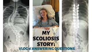 VLOG: having scoliosis