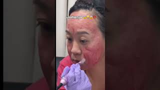 TREATMENT SANA SINI BOPENG GA HILANG - SETELAH PAKE DERMAPEN?????