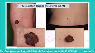 Dr. Kuroli Enikő a melanomáról - Melanoma Világnap2020