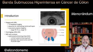 Banda Submucosa Hiperintensa para diferenciar estadiaje T0-T1 de T23 en Cancer de Cólon