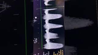 How to calculate TR jet in RDS PPHN preterm and How calculate SD DD ratio for RV function in PPHN