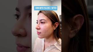 Before and after Chin with fillers💖