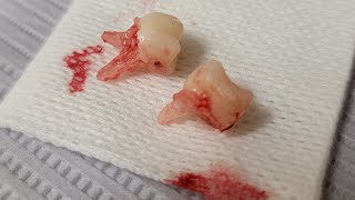 Wisdom teeth extraction