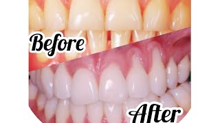 How to whiten your teeth at home with only $0.5 / hydrogen peroxide 3%