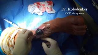 Sterile Application of KCI Wound VAC HD