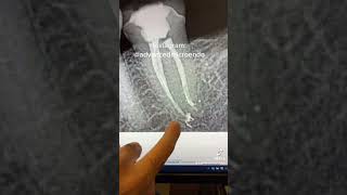 Root canal therapy of tooth #18. #dentist #toothdental #dentalprocedure #rootcanal