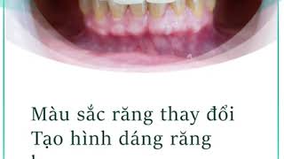 Hình ảnh khách hàng thực hiện răng sứ tại nha khoa Sài Gòn Bình Dương