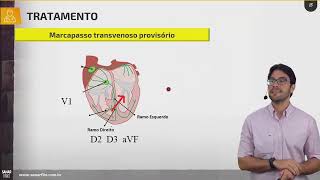 Bradiarritmias - Parte 2