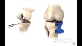 Unicondylar Knee Replacement