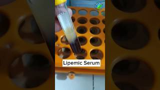 Lipemic Serum | hyperlipidemia #medicallaboratory #bloodtest #medicallab