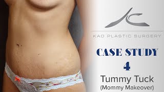 Case Study 4: Susan (Tummy Tuck Mommy Makeover)