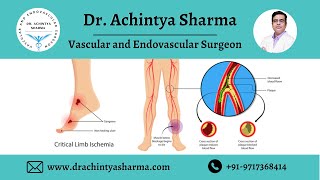 What is Peripheral Artery Disease? || Dr. Achintya Sharma