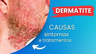 COMO TRATAR A DERMATITE [SAIBA AGORA]