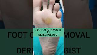 CORN REMOVAL BY DERMATOLOGIST @DrArifMDDermatologist #corn