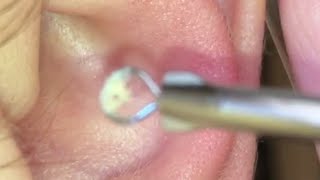 Cleaning 👂 blackheads