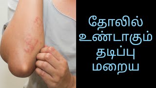 தோல் தடிப்பு| நகம் கீறினால் உண்டாகும் தடிமன்| அலர்ஜி| shorts