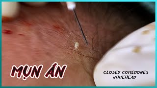 Big Cystic Acne Blackheads Extraction Blackheads & Milia, Whiteheads Removal Pimple Popping