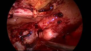 laparoscopic surgery for intestinal obstruction after hysterectomy due to blood clot