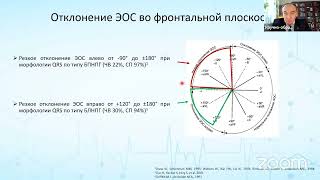 Дифференциальная диагностика аритмий с широкими комплексами QRS на основе анализа поверхностной ЭКГ