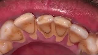 দেখুন কিভাবে দাঁত ক্লিন করা হয়। Dental Scaling in Tech Dental Bangladesh