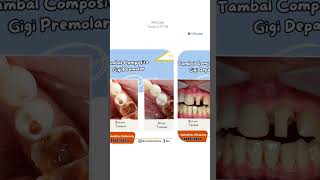 Before and after cabut dan tambal gigi di xxonedentalcare #shorts Dokter Gigi Kota Metro