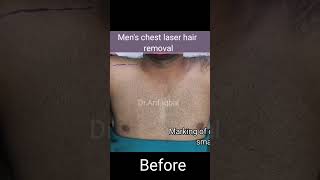 Men's Chest Laser Hair Removal Treatment By Dr.Arif Iqbal #ashortaday #skin #treatment #hairremoval