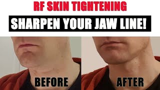 Update after one year using RF Skin Tightening: My New Jawline!