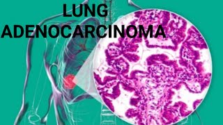 What is Lung Adenocarcinoma? symptoms and treatment | Dr Academy