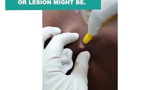 IS SKIN BIOPSY PAINFUL ? WHERE CAN I GET SKIN BIOPSY DONE IN KOCHI | SIMPLE PROCEDURE  @ SKINSECRETS