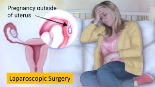 Laparoscopic Ectopic Pregnancy | Cornual ectopic pregnancy (interstitial pregnancy) Surgery