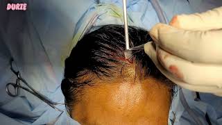 Endoscopic excision of forehead osteoma through browlift approach #Osteoma, #forehead , #endoscopic