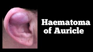 haematoma of the auricle