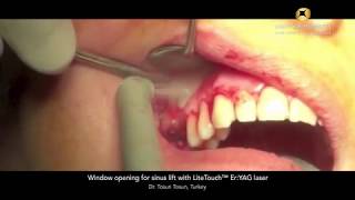 Window opening for sinus lift with LiteTouch™ Er:YAG laser