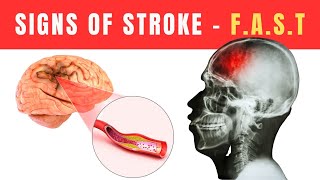 Signs of Stroke - How to Spot a Stroke in Minutes Using the FAST Method