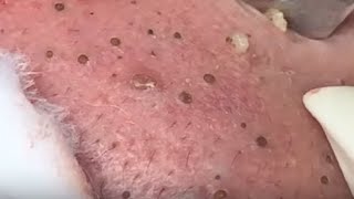 SUPER GIANT BLACKHEAD is here, Oddly Video Face Skin with Calm Music