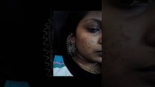 My real life acne story and motivation video in tamil #acnestory #acne #shorts