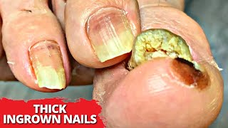 THICK Ingrown Nail Debridement On Actor Patient!