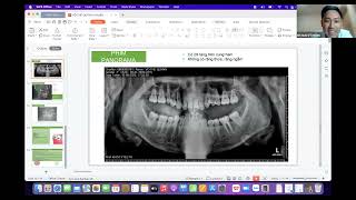 Case lâm sàng hạng 2 góc thấp, cắn sâu. có nên nhổ răng hay không ?