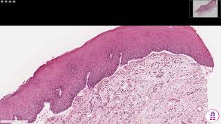 Mucous membrane pemphigoid