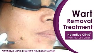 Wart Removal Treatment | Best Warts Removal With Laser Treatment | Navadiya Skin Care