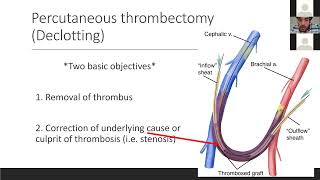 Advancements in Dialysis Declotting: AV Thrombectomy and the use of CLEANER